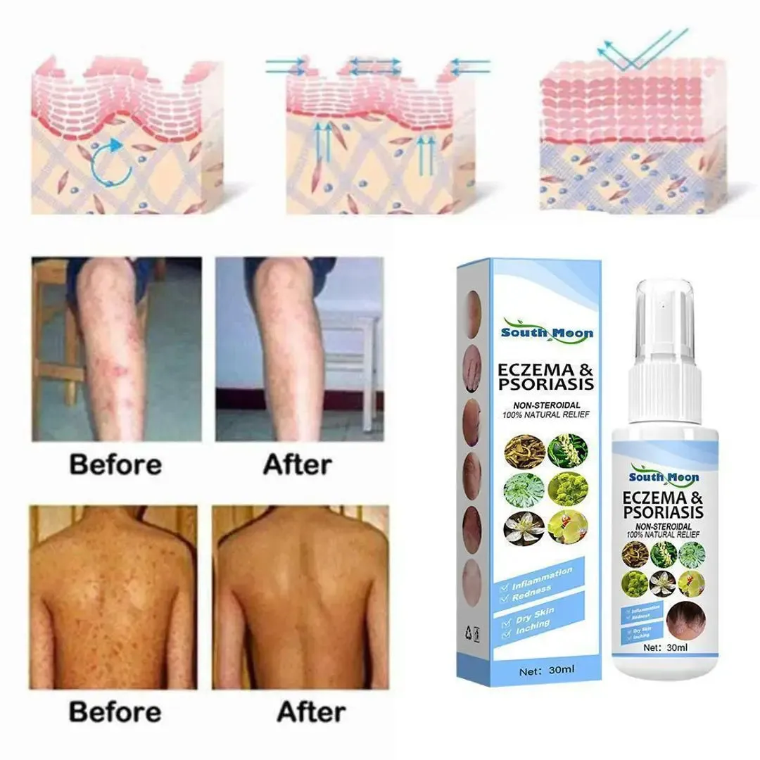 Herbal Psoriasis Relief Spray